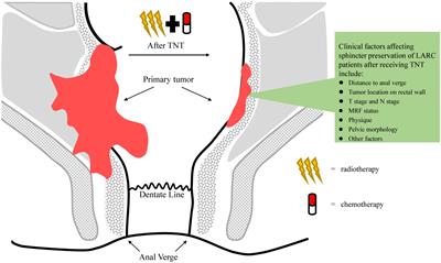 Total neoadjuvant treatment and PD-1/PD-L1 checkpoint inhibitor in locally advanced rectal cancer